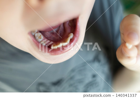 A 10-year-old boy shows a fresh empty socket in his lower jaw after losing a baby tooth. He holds the shed milk tooth in his hand, highlighting natural childhood development and dental growth. A 10-year-old boy shows a fresh empty socket in his lower jaw after losing a baby tooth. He holds the shed milk tooth in his hand, highlighting natural childhood development and dental growth. 140341337
