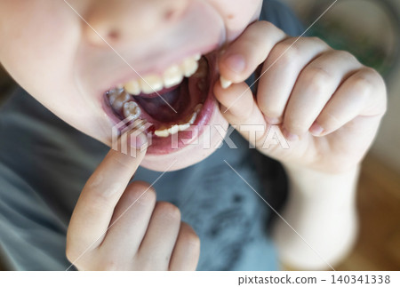 A 10-year-old boy shows a fresh empty socket in his lower jaw after losing a baby tooth. He holds the shed milk tooth in his hand, highlighting natural childhood development and dental growth. A 10-year-old boy shows a fresh empty socket in his lower jaw after losing a baby tooth. He holds the shed milk tooth in his hand, highlighting natural childhood development and dental growth. 140341338