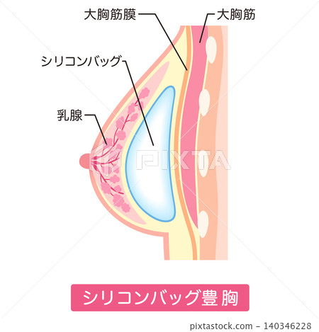 矽膠隆乳假體、隆乳手術類型、整形手術、乳房 矽膠隆乳假體、隆乳手術類型、整形手術、乳房 140346228