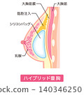 Hybrid breast augmentation; Types of breast augmentation surgery; Cosmetic surgery; Breasts 140346250