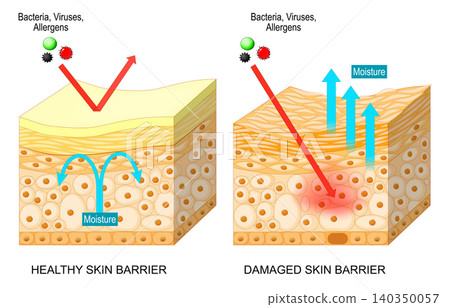 Skin barrier. Cross section of epidermis. Comparison of healthy and damaged skin barrier layers. 140350057