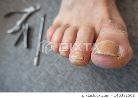 Male Foot with Damaged Toenails and Dry Skin with Pedicure Tools Male Foot with Damaged Toenails and Dry Skin with Pedicure Tools 140351501