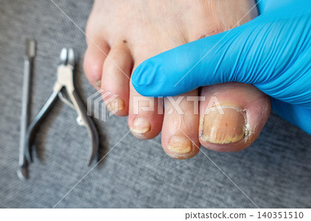Podiatry Examination of Male Foot with Medical Gloves and Treatment Tools Podiatry Examination of Male Foot with Medical Gloves and Treatment Tools 140351510