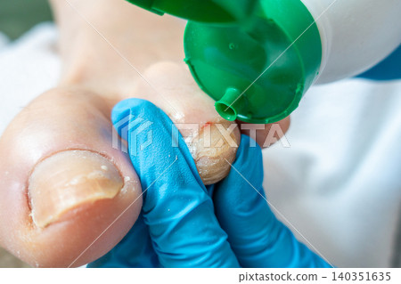 Applying Antiseptic to Injured Toe During Professional Pedicure Treatment 140351635