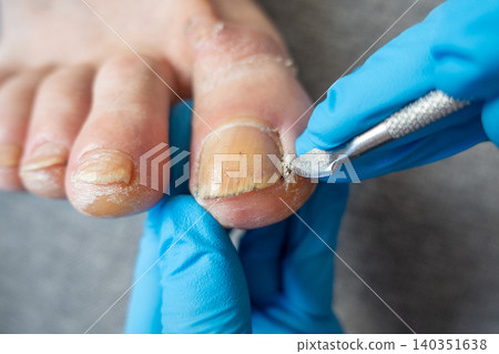 Professional Cleaning of Toenail Sidewall During Foot Care Treatment 140351638