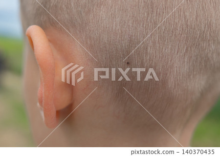 Detailed close-up shot of a dangerous parasite tick on a child's head skin under short hair. Perfect medical concept for Lyme disease awareness, encephalitis prevention, and pediatric healthcare 140370435