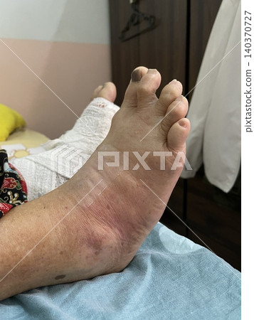 Swollen Foot and Bandaged Leg Swollen Foot and Bandaged Leg 140370727