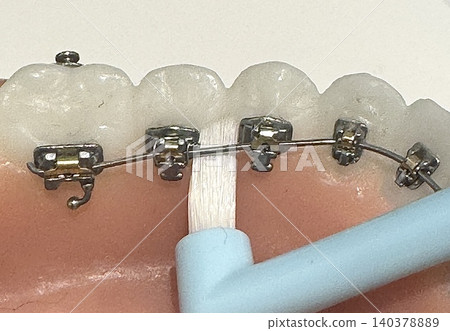 Brushing teeth with lingual braces 140378889