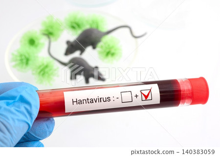 Hantavirus positive blood test results showing viral infection 140383059