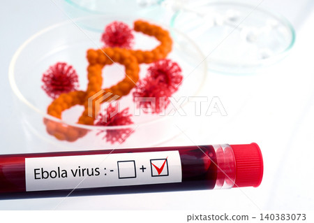 Ebola virus positive blood test result in laboratory setting Ebola virus positive blood test result in laboratory setting 140383073
