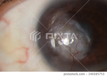 Clinical slit lamp close-up of corneal vessels invading a scarred central cornea Clinical slit lamp close-up of corneal vessels invading a scarred central cornea 140385753