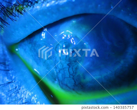 Detailed anterior segment image of severe vascularized pannus associated with chronic ulcer under cobalt blue filter Detailed anterior segment image of severe vascularized pannus associated with chronic ulcer under cobalt blue filter 140385757