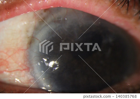 Corneal neovascularization. Slit-lamp photograph showing abnormal blood vessel growth extending onto the cornea secondary to chemical injury 140385768