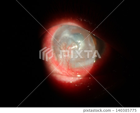 Slit lamp close-up demonstrating dense pannus formation from long-standing corneal ulcer 140385775