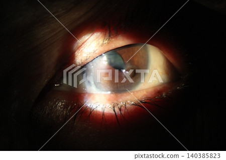 Iris Prolapse. Close-up of iris prolapse through corneal wound under slit-lamp examination Iris Prolapse. Close-up of iris prolapse through corneal wound under slit-lamp examination 140385823
