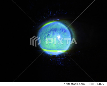 Close-up slit-lamp image showing fluorescein-stained corneal epithelial defect with irregular abrasion on the central cornea 140386077
