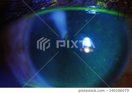Close-up slit-lamp view demonstrating multiple pinpoint corneal abrasions stained with fluorescein 140386079