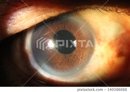Diffuse corneal abrasion associated with ocular surface dryness Diffuse corneal abrasion associated with ocular surface dryness 140386088