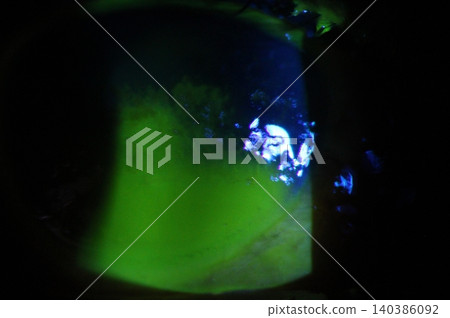Fluorescein-stained corneal abrasion observed under cobalt blue illumination using a slit lamp biomicroscope 140386092