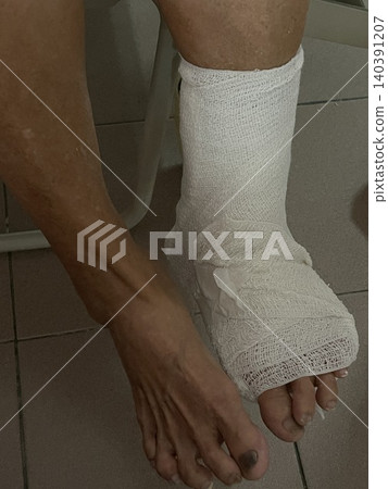 Elderly Person Injured Foot in Plaster Cast Elderly Person Injured Foot in Plaster Cast 140391207