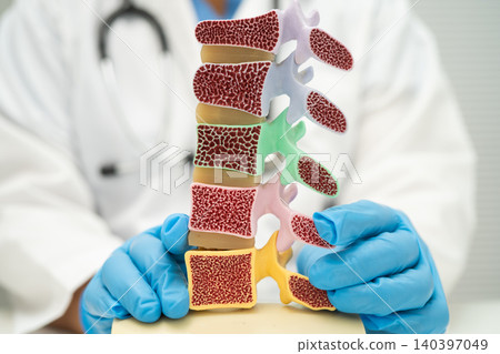 Doctor holding osteoporosis in back bone model. Doctor holding osteoporosis in back bone model. 140397049