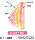 Fat-grafted breasts; structure of breast augmentation surgery; fat grafting breast augmentation. 140425322