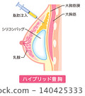 Hybrid breast augmentation; Types of breast augmentation surgery; Cosmetic surgery; Breasts 140425333