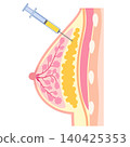 Fat-grafted breasts; structure of breast augmentation surgery; fat grafting breast augmentation. 140425353