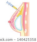 Hybrid breast augmentation; Types of breast augmentation surgery; Cosmetic surgery; Breasts 140425358