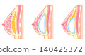 Types of breast augmentation surgery; cosmetic surgery; breasts 140425372