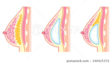隆乳手術類型;整形手術;乳房 隆乳手術類型;整形手術;乳房 140425372