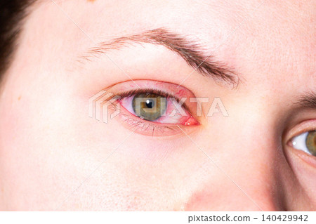 Female patient with painful red eye symptom. Seeking professional ophthalmologist care. Importance of timely eye exams. Drops therapy for infection recovery Female patient with painful red eye symptom. Seeking professional ophthalmologist care. Importance of timely eye exams. Drops therapy for infection recovery 140429942