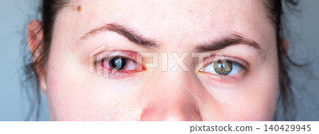 Uncomfortable red eye and enlarged pupil after medicated drops. Allergic or bacterial conjunctivitis. Visual for Ophthalmologist and Professional eye care clinic Uncomfortable red eye and enlarged pupil after medicated drops. Allergic or bacterial conjunctivitis. Visual for Ophthalmologist and Professional eye care clinic 140429945