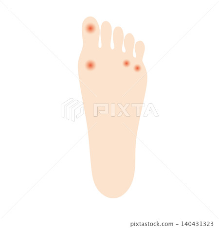 An illustration of a callus on the sole of a foot. 140431323