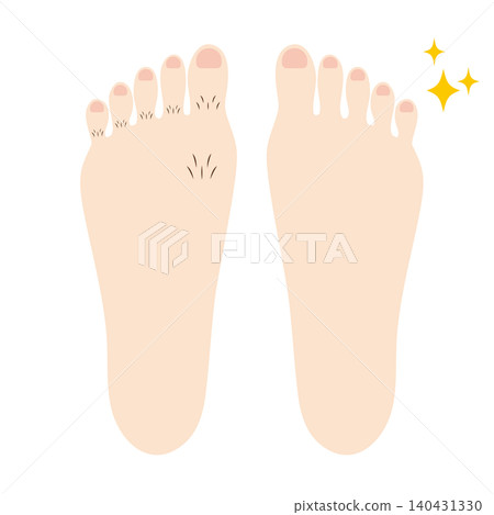 腳趾毛髮明顯增加的前後對比照片。 140431330