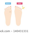 Before and after photos of feet with noticeable toe hair. 140431331