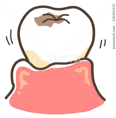 An illustration of teeth that are loose due to cavities and periodontal disease. An illustration of teeth that are loose due to cavities and periodontal disease. 140445432