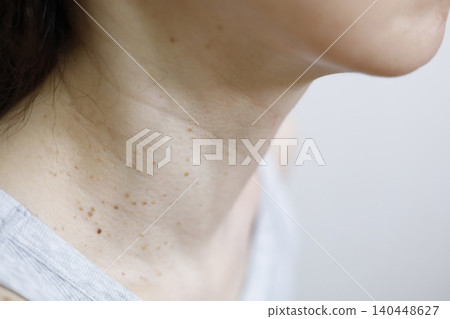皮膚問題:女性頸部疣 皮膚問題:女性頸部疣 140448627