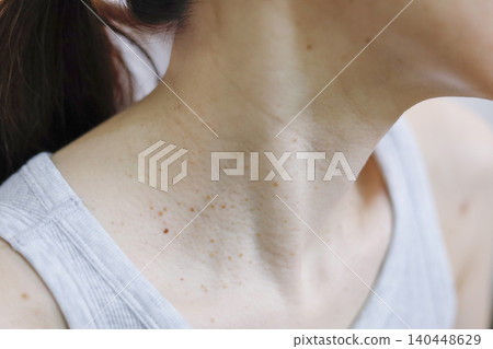 Skin problems: Warts on a woman's neck Skin problems: Warts on a woman's neck 140448629