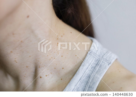 Skin problems: Warts on a woman's neck Skin problems: Warts on a woman's neck 140448630