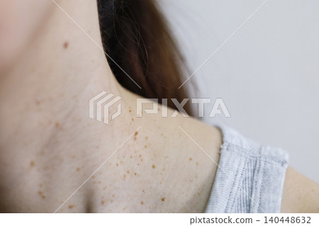 Skin problems: Warts on a woman's neck Skin problems: Warts on a woman's neck 140448632