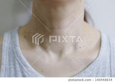皮膚問題:女性頸部疣 皮膚問題:女性頸部疣 140448634