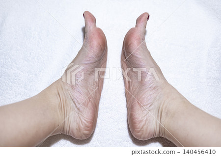 Dry skin on the feet, woman heel 140456410