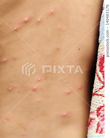 chicken pox disease in children chicken pox disease in children 140465176