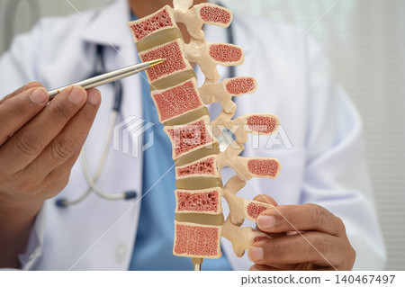 Doctor holding osteoporosis in back bone model for treatment medical in orthopedic department. Doctor holding osteoporosis in back bone model for treatment medical in orthopedic department. 140467497
