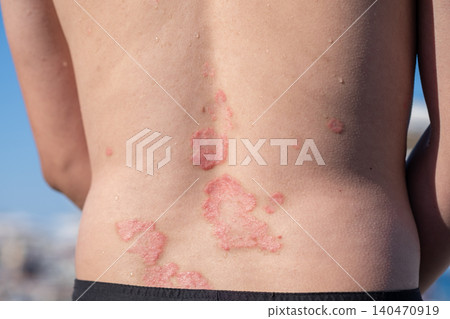Back of an individual displays patches of psoriasis under bright sunlight, highlighting the skin condition in an outdoor setting. Back of an individual displays patches of psoriasis under bright sunlight, highlighting the skin condition in an outdoor setting. 140470919