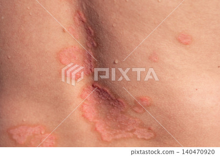 Close-up view of skin affected by psoriasis, showing red patches and flaking, highlighting the severity of the skin condition on the back area Close-up view of skin affected by psoriasis, showing red patches and flaking, highlighting the severity of the skin condition on the back area 140470920