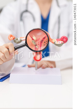 Doctor with Uterus and Ovaries anatomy model. Ovarian and Cervical cancer, Cervix disorder, Endometriosis, Hysterectomy, Uterine fibroids, Reproductive system, Pregnancy and health concept 140473011