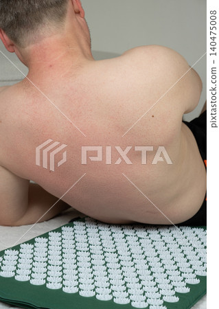 Male back with redness and marks from massage spikes on acupuncture mat Male back with redness and marks from massage spikes on acupuncture mat 140475008
