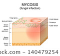 Skin Fungal infection. Mycosis. Skin disease caused by fungi. Dermatophyte, hyphae and spore invasion skin layer. Dermatology. 140479254